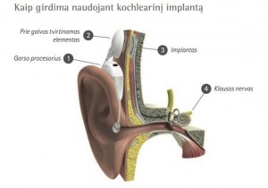Kaip girdima naudojant kochlearinį implantą. Biomedikos centro schema